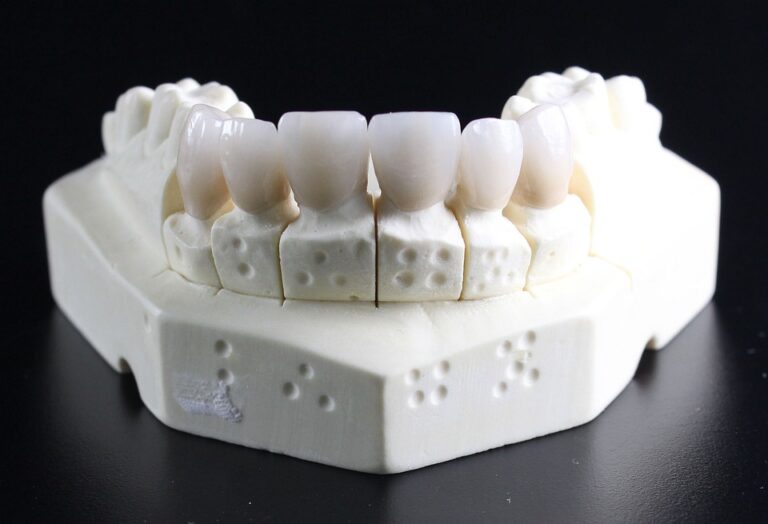 tooth replacement 759929 960 720